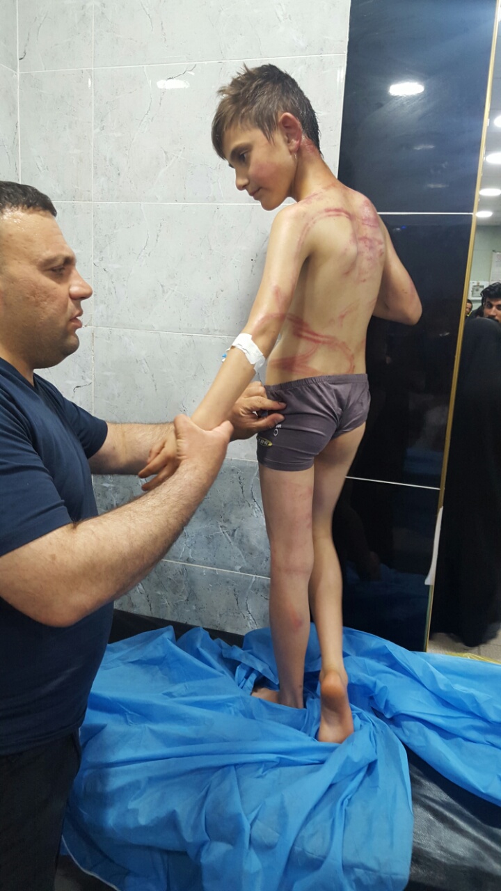 A 10-year-old boy named Ali from Kirkuk Province was delivered to the emergency room, showing severe signs of torture and bruises all over his body, April 17, 2017. (Photo: Social Media)